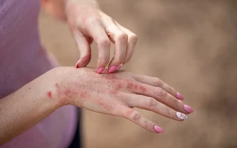ECZEMA, EPIGENETICS AND THE POWER TO REPROGRAM